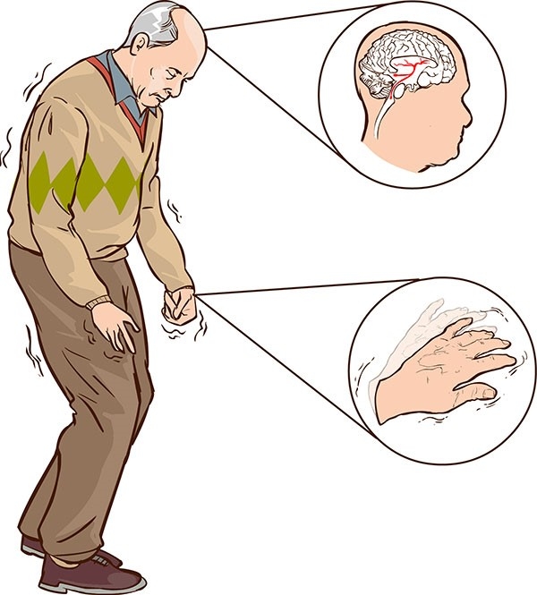 Các giai đoạn của Parkinson
